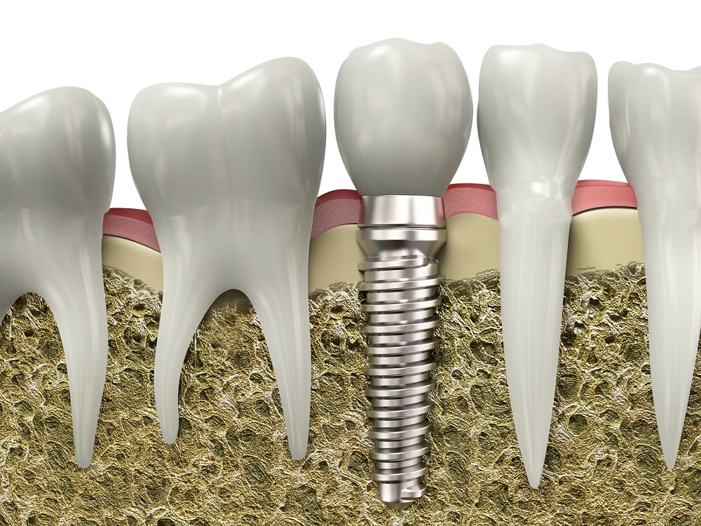 Dental Implants: Bridging Gaps with Precision and Care